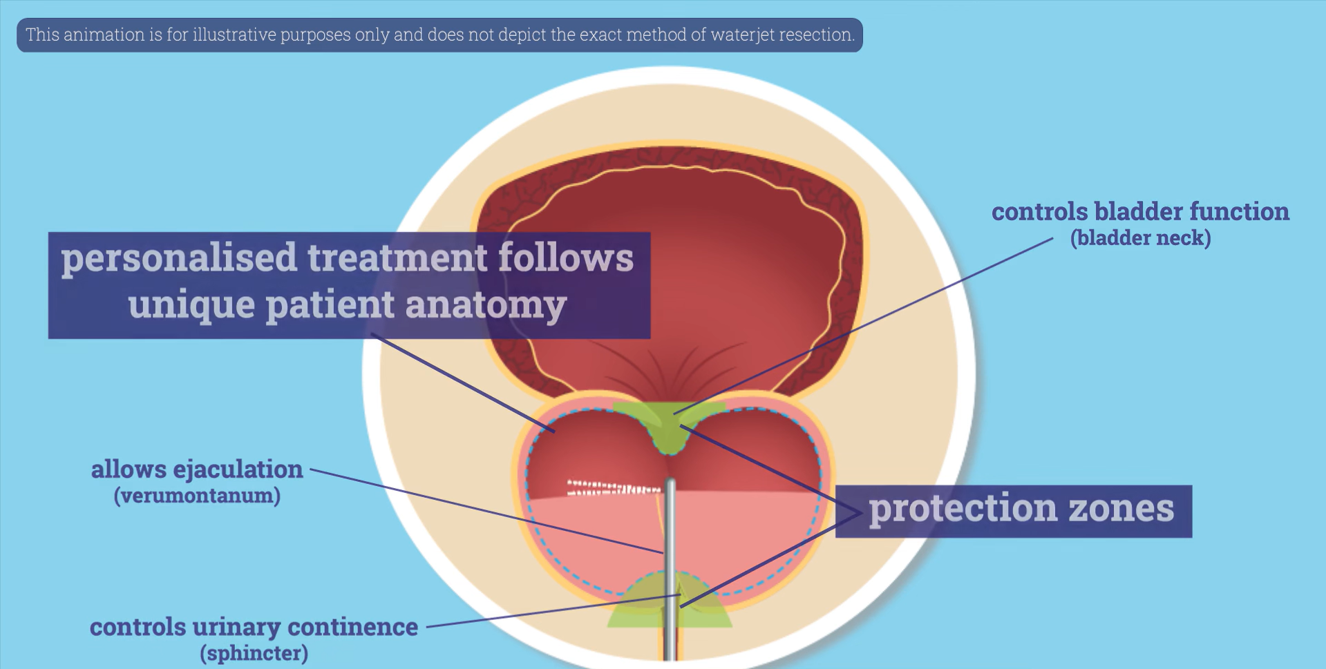 Prostate before and after Urolift